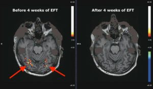 Functional Magnetic Resonance Imaging scans (fMRI) showing the effects on tapping on food cravings